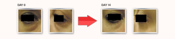Eyelasticity Before and After Results