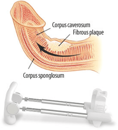 Sizegenetics can cure Peyronie's Disease